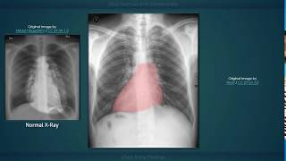 Situs Inversus with Dextrocardia Explanation of Chest Xray Findings [upl. by Akciret]