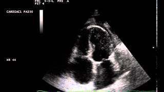 constrictive pericarditis septal bounce [upl. by Adnaluoy878]