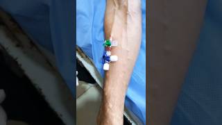 IV Cannulation subscribe cannula cannulation health hospital shortsindia [upl. by Hephzibah]