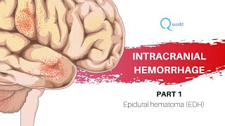 Intracranial Hemorrhage Part 1 of 4  Epidural hematoma EDH for USMLE and NEXTNEETPG [upl. by Onilatac154]