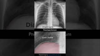 Pneumoperitoneum Chest Xray shorts [upl. by Adnuhs]