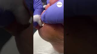 Pinch Callus Tyloma Removal [upl. by Enerak]