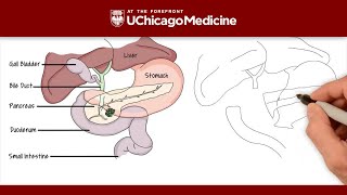 What is the Whipple procedure  UChicago Medicine [upl. by Mairym627]