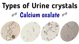 various types of calcium oxalate crystals seen in urine microscopic examination [upl. by Clift]