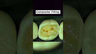 Composite Restoration Light cure restorationclass 2 composite Restoration [upl. by Layod]