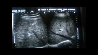 ultrasound of normal vs mild coarsese echogenic liver 2 0f 2 [upl. by Anolahs524]