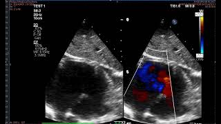 TAPVC coronary sinus variety [upl. by Zeiger]