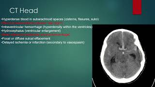 Subarachnoid Hemorrhage [upl. by Norrej]