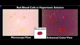 hemolysis crenation [upl. by Willock]