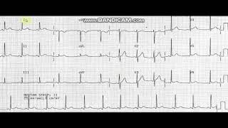 acute pericarditis ECG [upl. by Tibbitts]