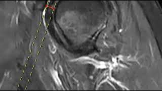 Coracoid impingement [upl. by Natehc]