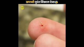 Splinter को तुरंत निकाल देना 😰  Remove Splinter Immediately  The Fact  shorts ytshorts [upl. by Ahsieit349]