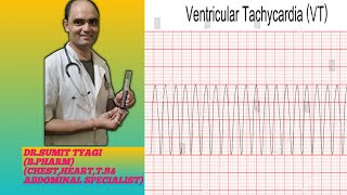 VENTRICULAR TACHYCARDIA BY DRSUMIT TYAGISUMITMEDICALDISPENSARY1 [upl. by Akienom731]