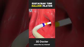 EustachianTube BalloonDilation EarHealthEarTreatment sinusrelief ENTProcedure HealthTips [upl. by Euqnimod923]