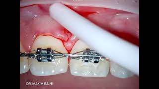 SUPERIOR LABIAL FRENECTOMY BY DOUBLE CLAMPING TECHNIQUE [upl. by Magdaia340]