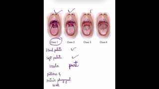 Modified Mallampati classification Anaesthesia [upl. by Munn]