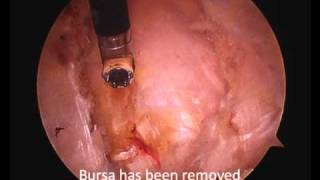 Arthroscopic Hip Bursectomy and Illiotibial Band Release [upl. by Ronald]