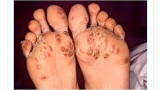 Keratoderma blennorrhagica in hindi  Tarang academy dermatology [upl. by Murrah478]