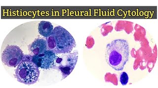 Histiocytes in Pleural Fluid for Cytology  Pleural Fluid Routine Examination [upl. by Ime]