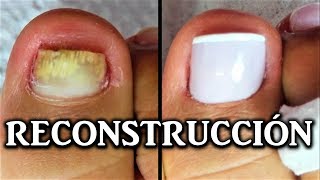 reconstruccion de uñas de pies con acrilico  nail reconstruction  reconstrução de unhas acrílico [upl. by Animsaj]