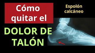 CÓMO QUITAR EL DOLOR DE TALÓN ESPOLÓN CALCÁNEO Y FASCITIS PLANTAR [upl. by Odelle541]