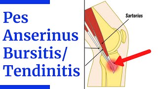 Pes Anserine BursitisTendinitis Evaluation [upl. by Merralee122]