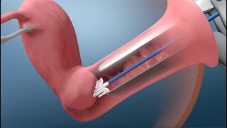 What Happens During a Pap Test [upl. by Benedikta661]