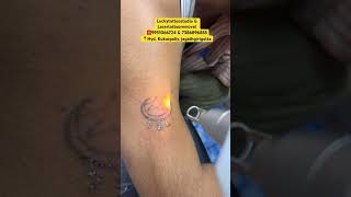 Lasertattooremoval Hyderabad ☎️9951066724 amp 7386896855 luckytattoostudio lasertattooremoval ink [upl. by Wendeline887]