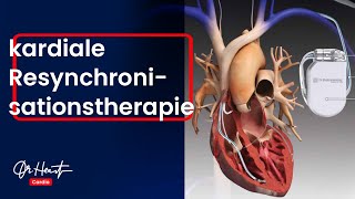 Kardiale Resynchronisationstherapie CRT  einfach erklärt  DrHeart [upl. by Stodder]