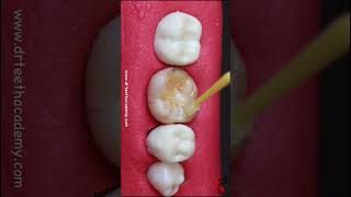 Treating cavities the correct way [upl. by Anhpad]