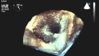 Feigenbaums Echocardiographythreedimensional transesophageal echocardiogram [upl. by Stanfield]