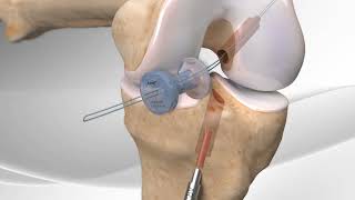 Rupture du ligament croisé antérieur  Chirurgie reconstruction LCA ligamentoplastie  Dr Tournemine [upl. by Fein]