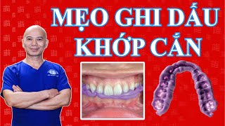 lấy dấu khớp cắn tại sao phải chuyển dấu khớp cắn cho Labo [upl. by Gustin]