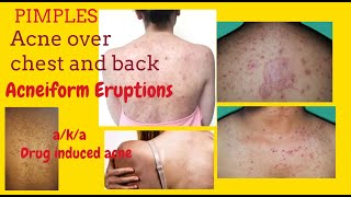 Pimples on chest and back or Acneiform Eruptions aka Drug induced acne  with Teratogenic Drugs [upl. by Flavia149]