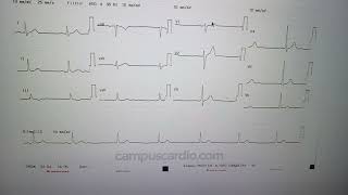 Electrocardiograma parte 11 medicina [upl. by Kcirde]