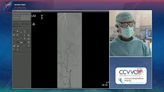 Chronic Total Occlusion Right SFA  LINC 2018 PAD Case 1  LeipzigSchmidt  Tues 851am [upl. by Sarajane]