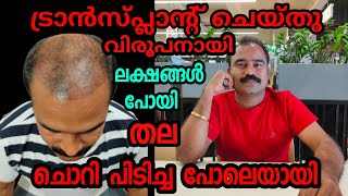 2 മാസത്തെ അനുഭവങ്ങൾ മുഴുവൻ കാണുക hair transplant ചെയ്താൽ സംഭവിക്കുന്നത് എന്ത് [upl. by Airdnaz696]