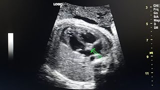 Right pulmonary aplasia in prenatal ultrasound [upl. by Nortal]