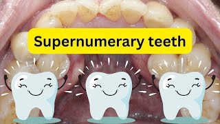 Supernumerary teeth SIMPLIFIED [upl. by Elleved]