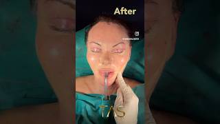 Scarless Facelift facelift necklift drsuleymantas beforeandafter tasmedicalcenter [upl. by Zuckerman]