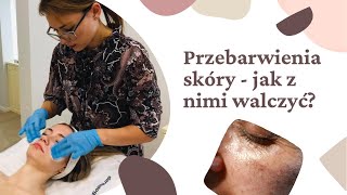 Jak walczyć z przebarwieniami skóry  Bellisimki odc 2 [upl. by Atnwahs291]