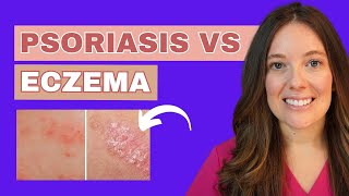 Do you Have Psoriasis or Eczema [upl. by Aniretak918]