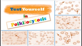 Review 📝  RBCs Morphological Abnormalities Poikilocytosis [upl. by Sul]