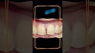 Teeth  Teeth gap filling  Teeth gap filling treatment [upl. by Arek]