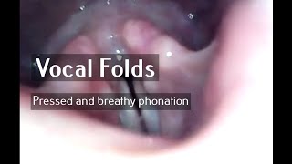 Vocal folds in hyper and hypofunctional pressed breathy phonation [upl. by Niles]