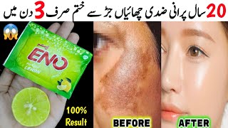 Remove 10 Years Old Pigmentation Dark Spots Freckles Melasma in 3 days  Home Remedies  Skincare [upl. by Odnamla]