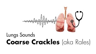 Coarse Crackles Rales  Lung Sounds  Medzcool [upl. by Trevorr]