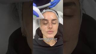 Amber Davies 4th Session of Endymed Facial Tightening Treatment at Dr MediSpa [upl. by Brenden]