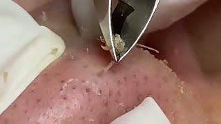 Tweezer Triumph Massive Nose Blackhead Removal [upl. by Ayanal]