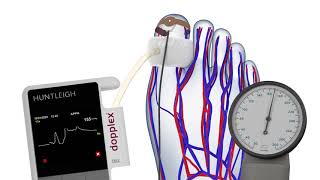 How to Measure the Toe Pressure Index TBI [upl. by Larrad391]